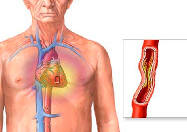 اعراض انسداد شرايين القلب